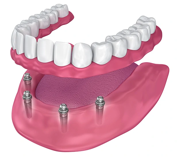 3D rendering of an All-on-4 dental implant system with a prosthetic denture.
