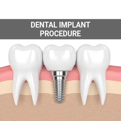 Illustration of a dental implant between two natural teeth in a jawbone cross-section.
